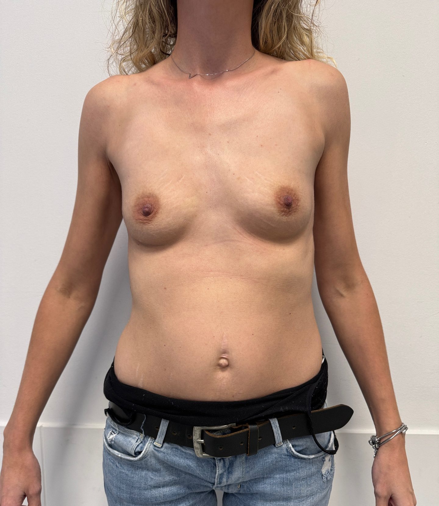 Breast augmentation before
