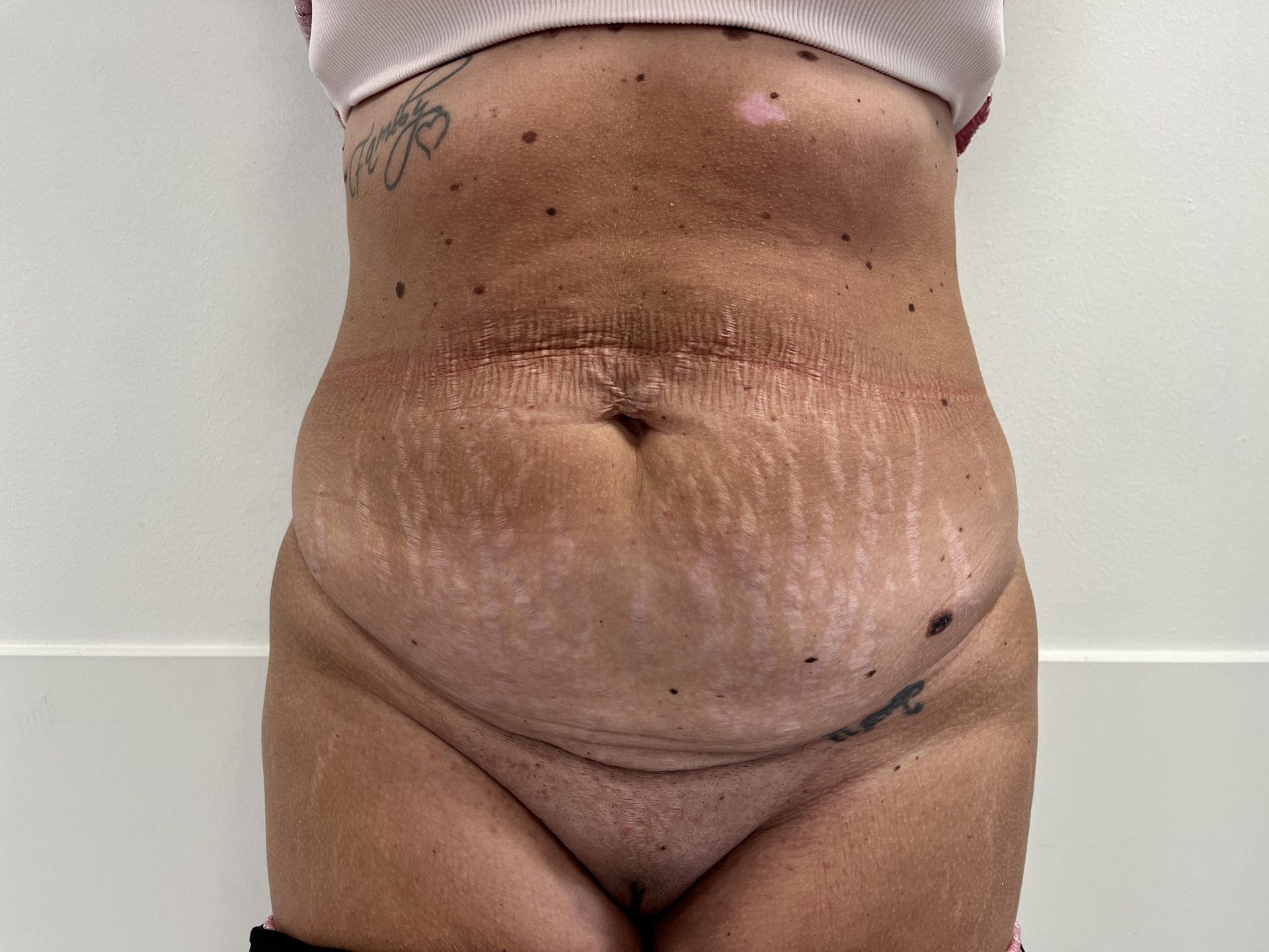 Tummy tuck before