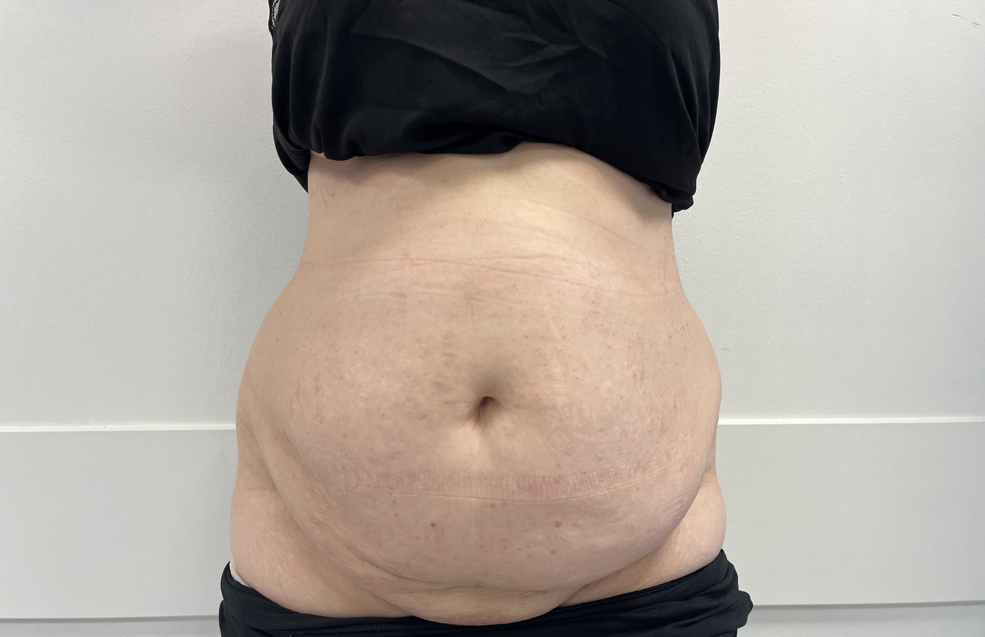 Tummy tuck before