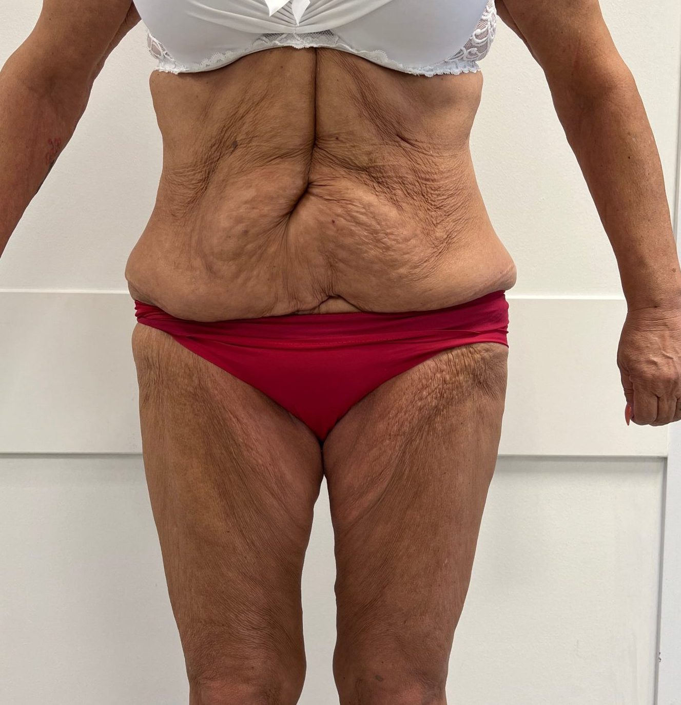 Tummy tuck before