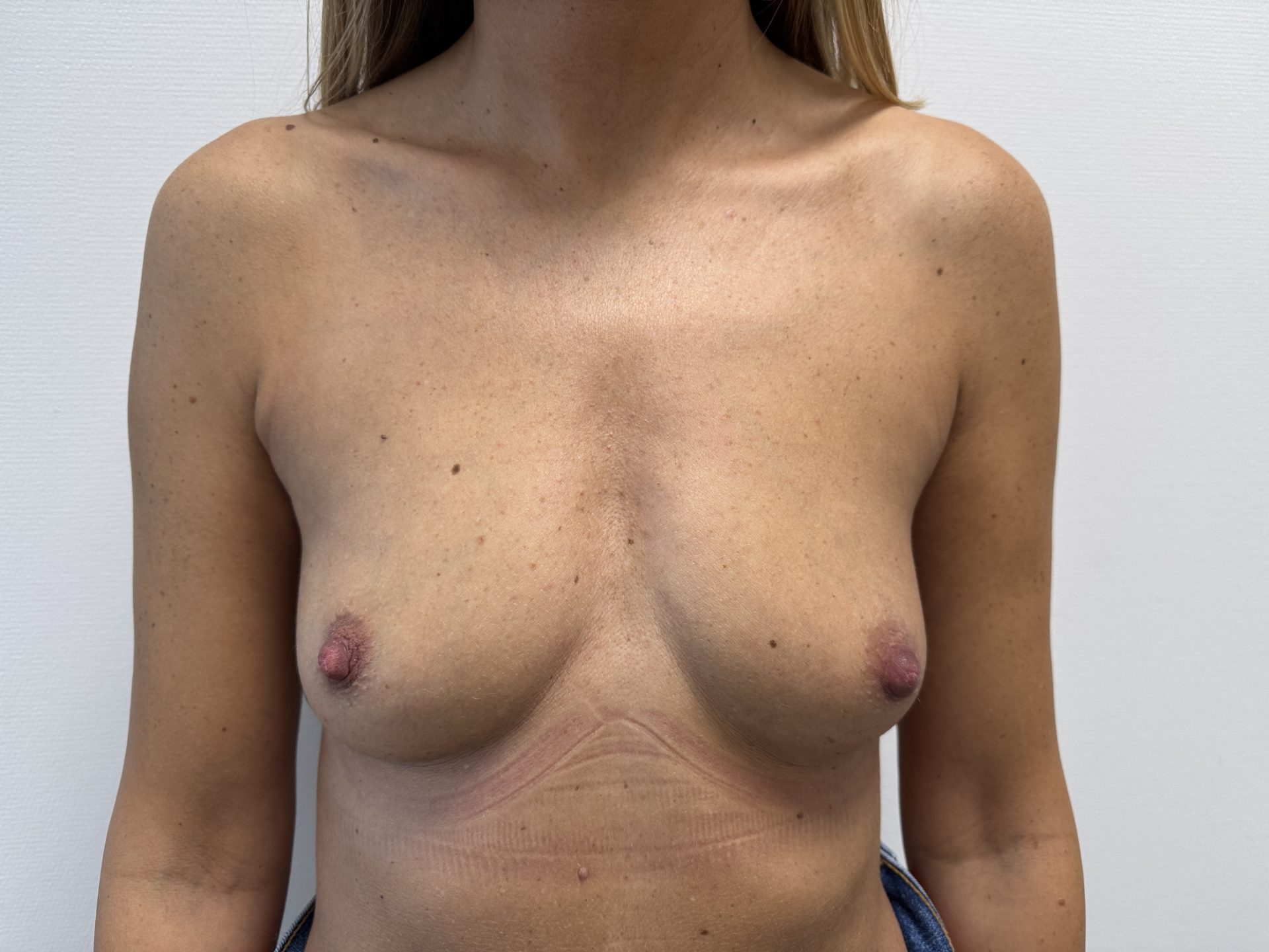 Breast augmentation before