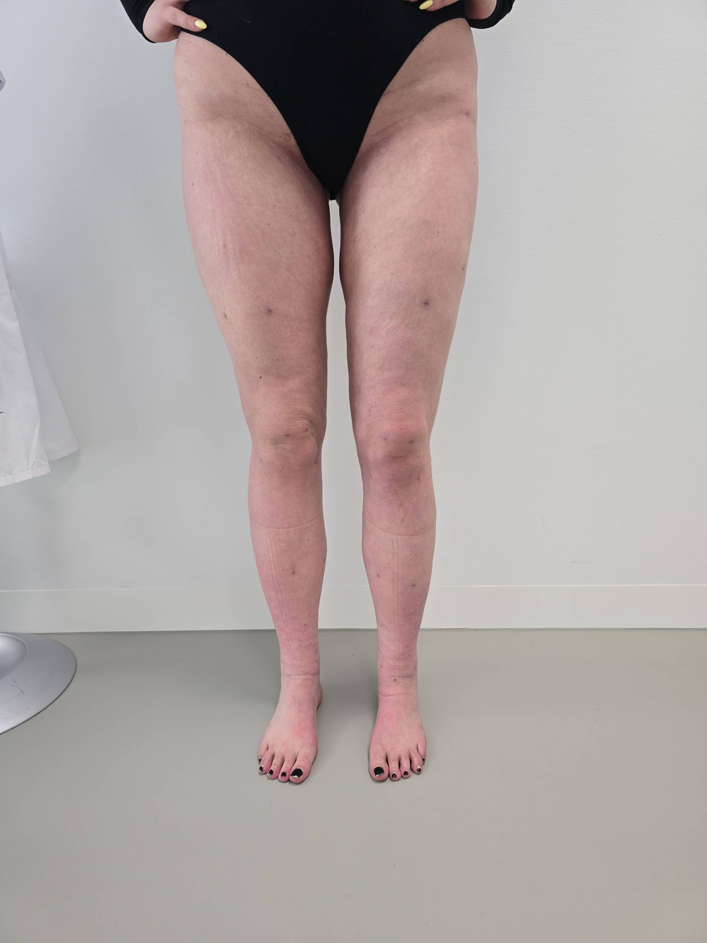 Lipoedema after