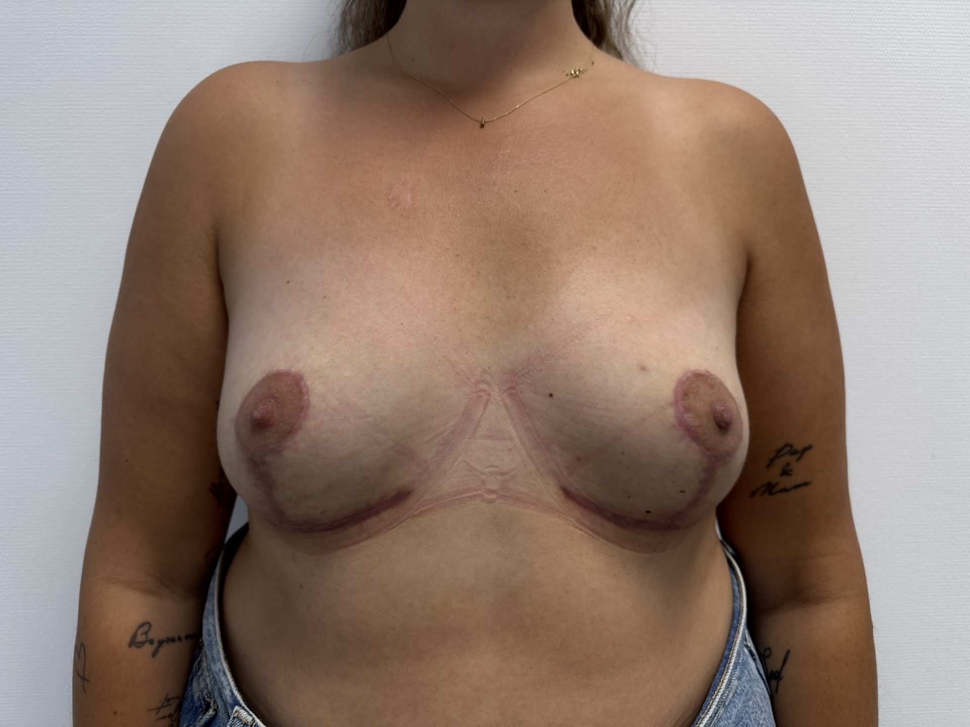 Breast lift after