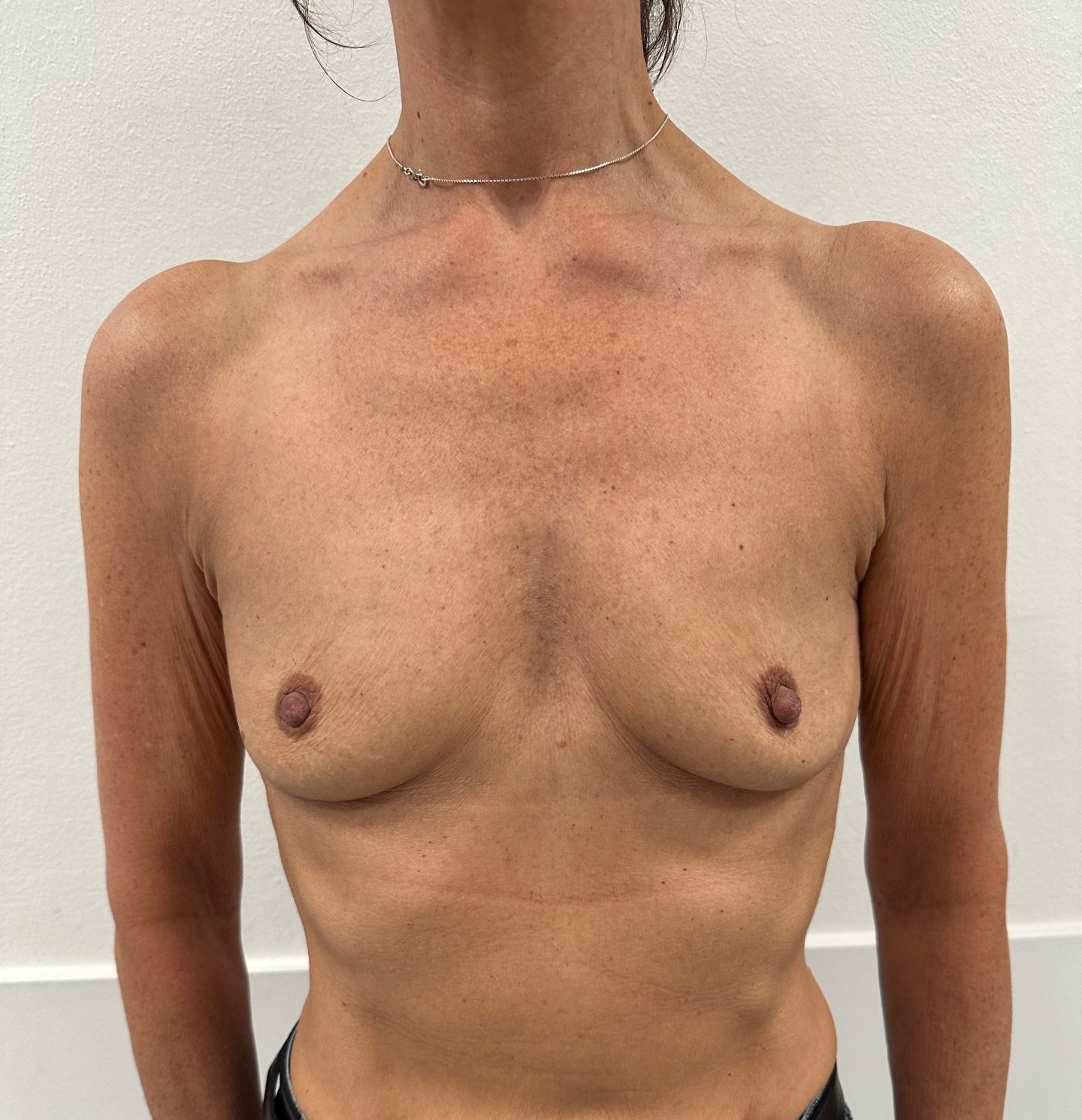 Breast augmentation before