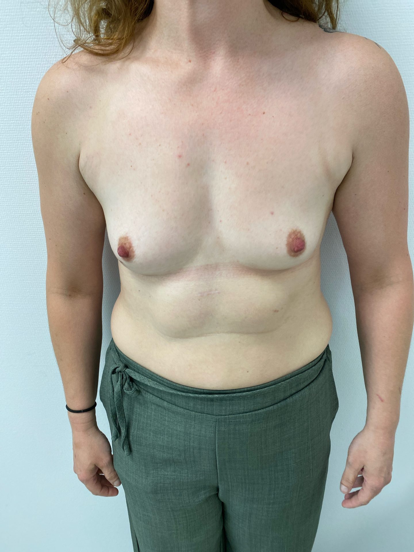 Breast augmentation before
