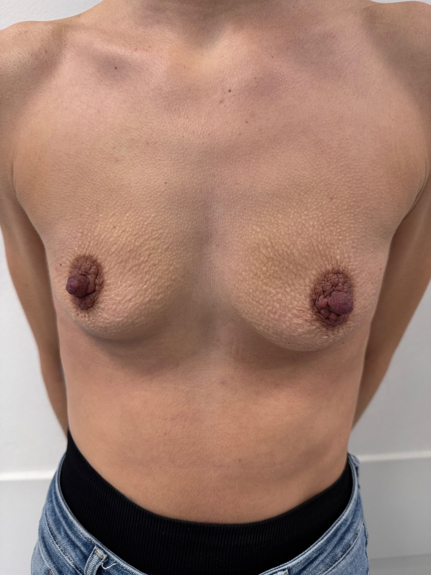 Breast augmentation before