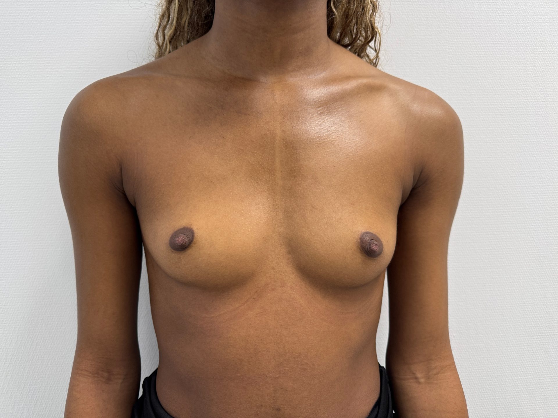 Breast augmentation before