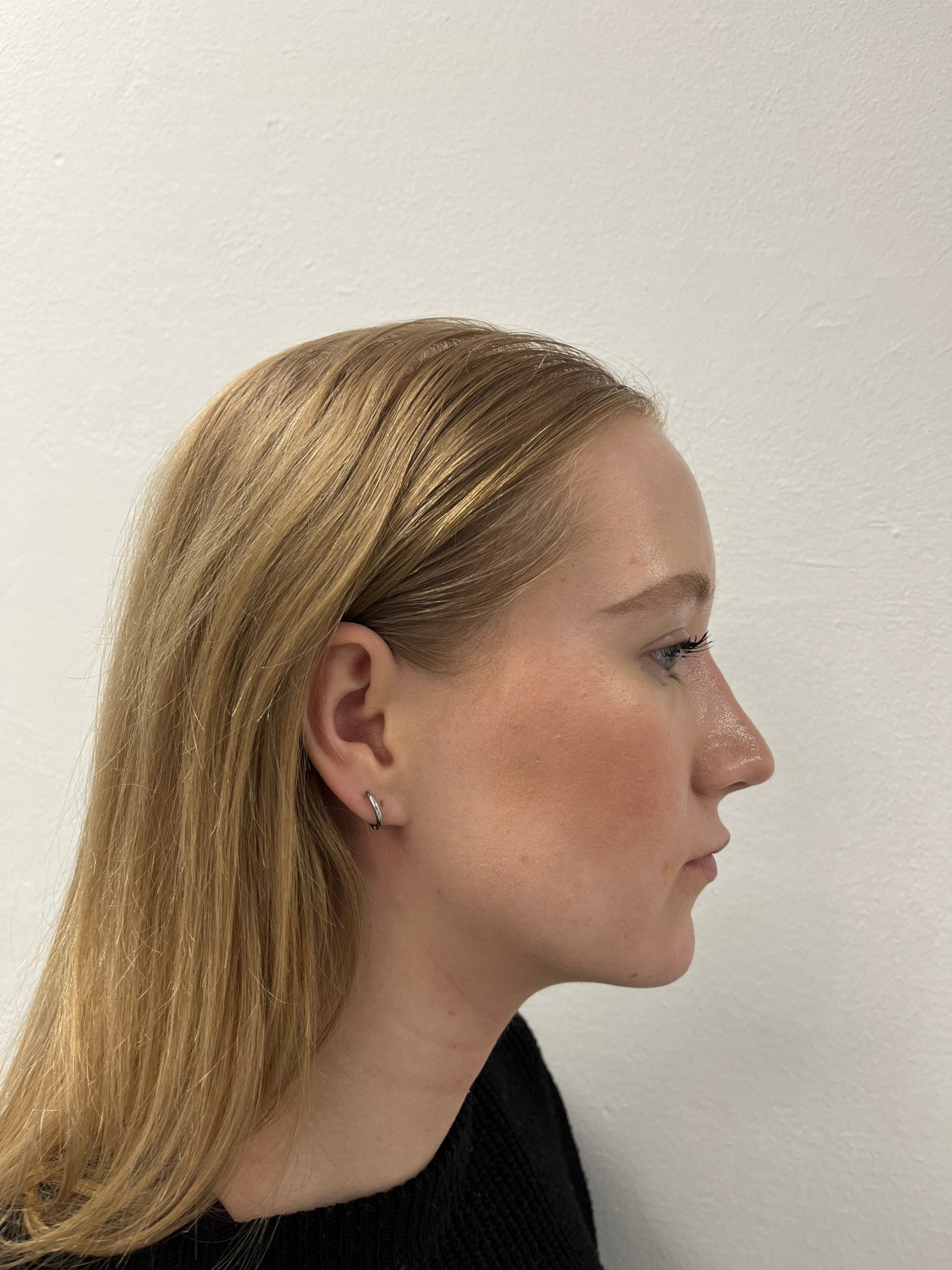 Nose correction after