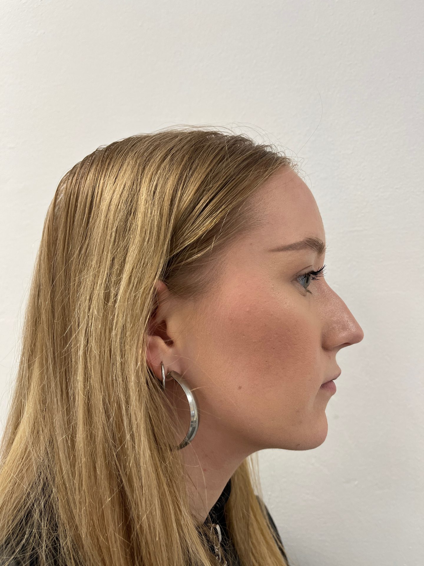 Nose correction before