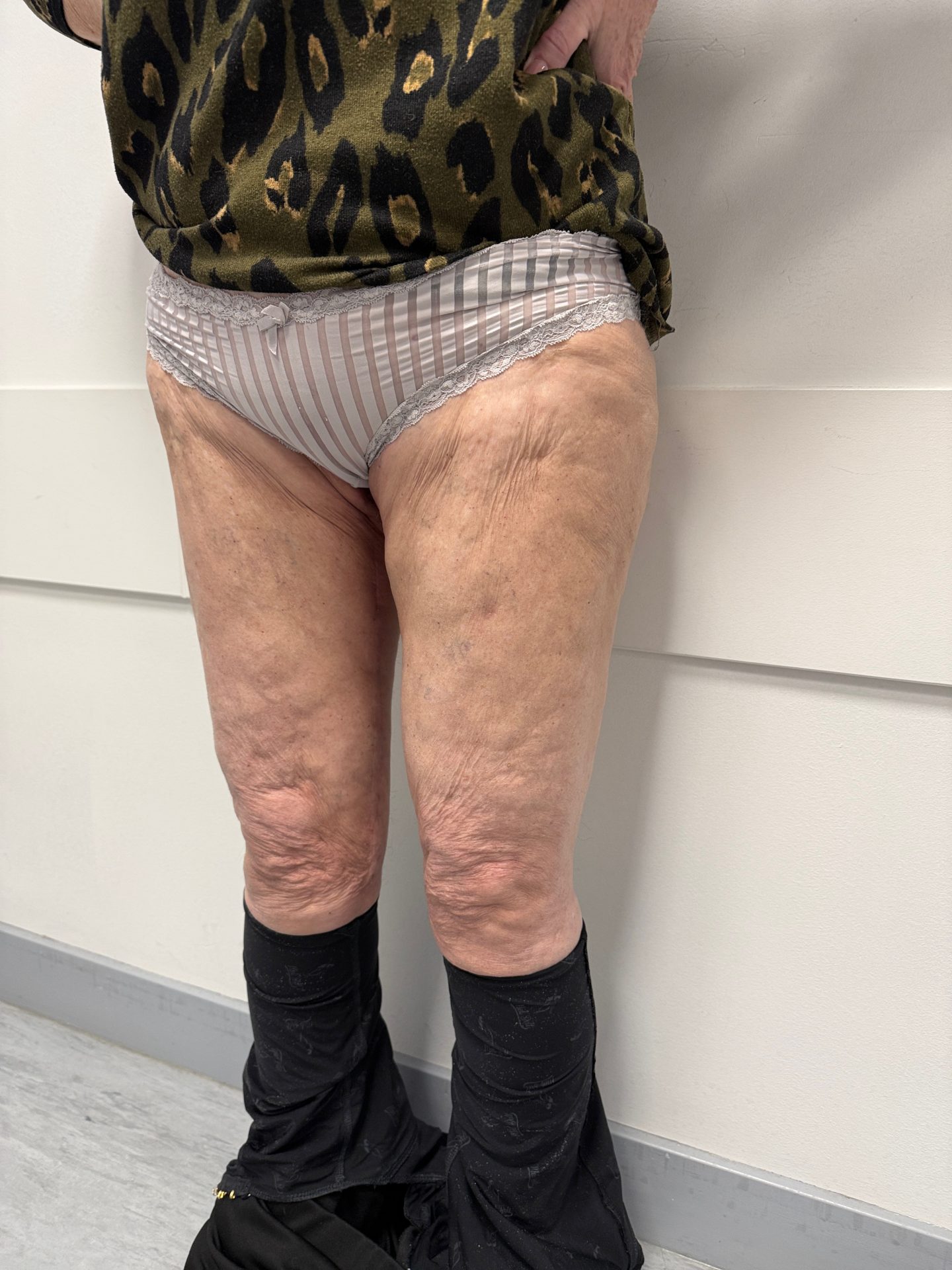 Thigh lift after