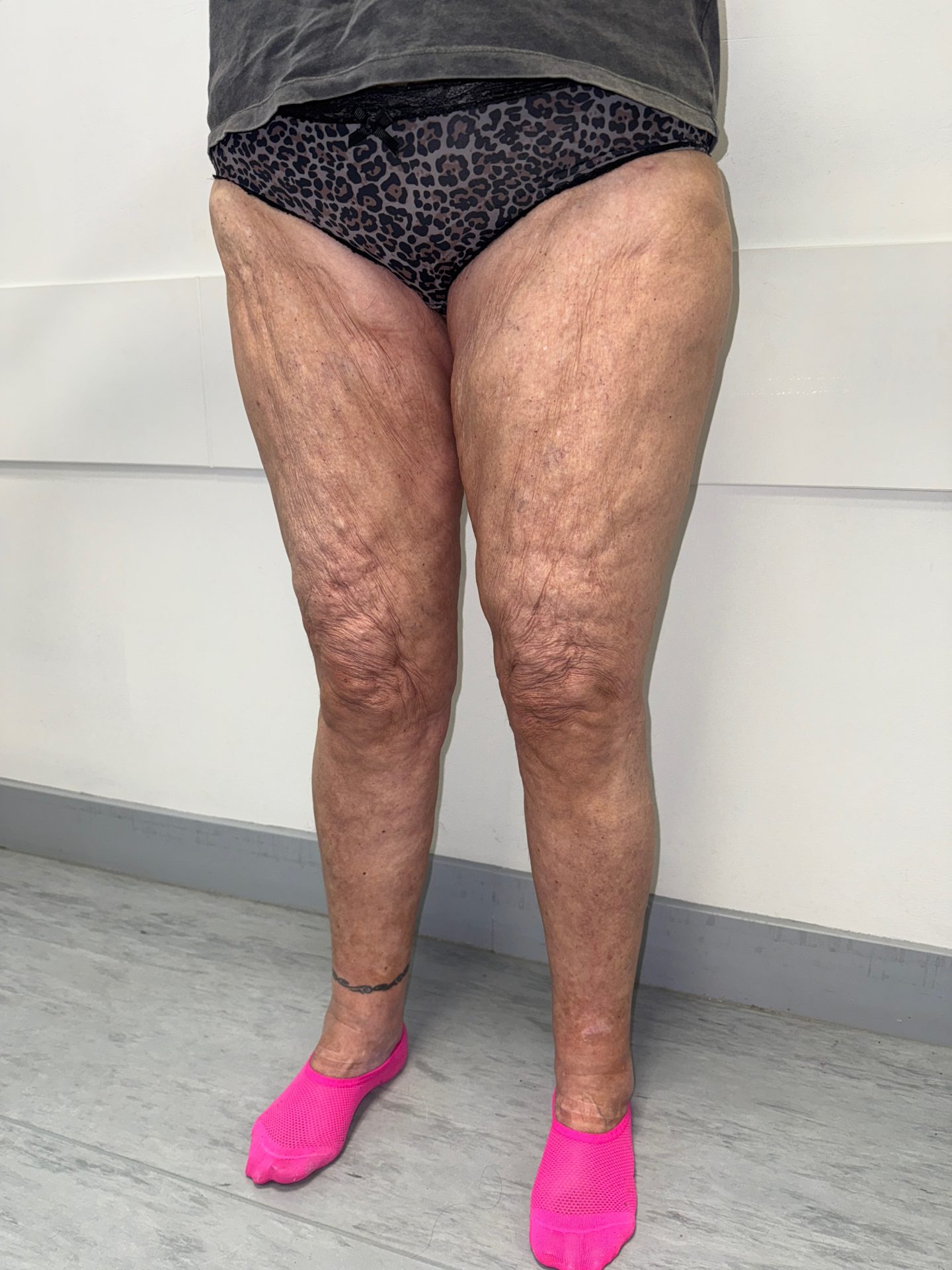 Thigh lift before