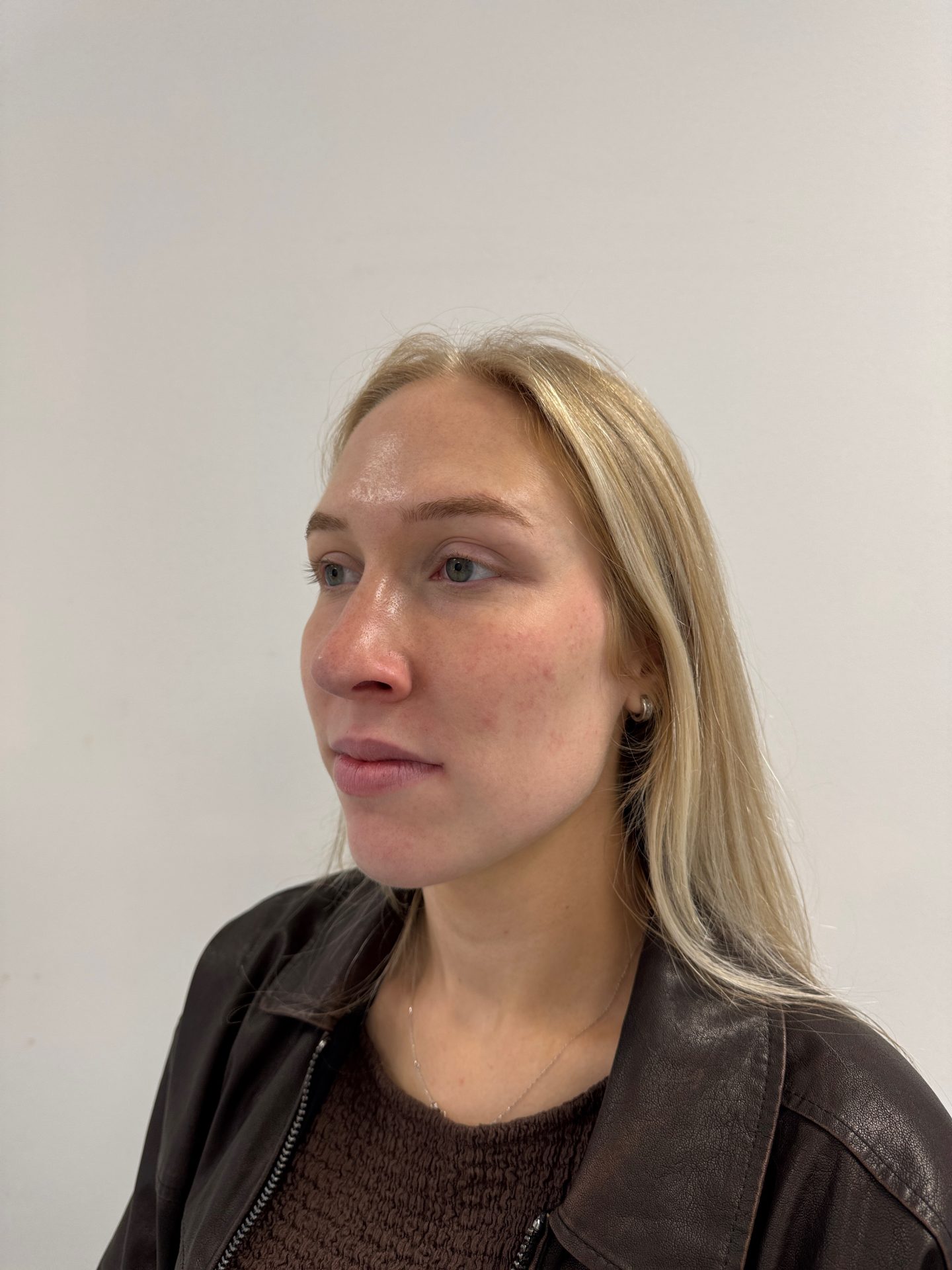 Nose correction after
