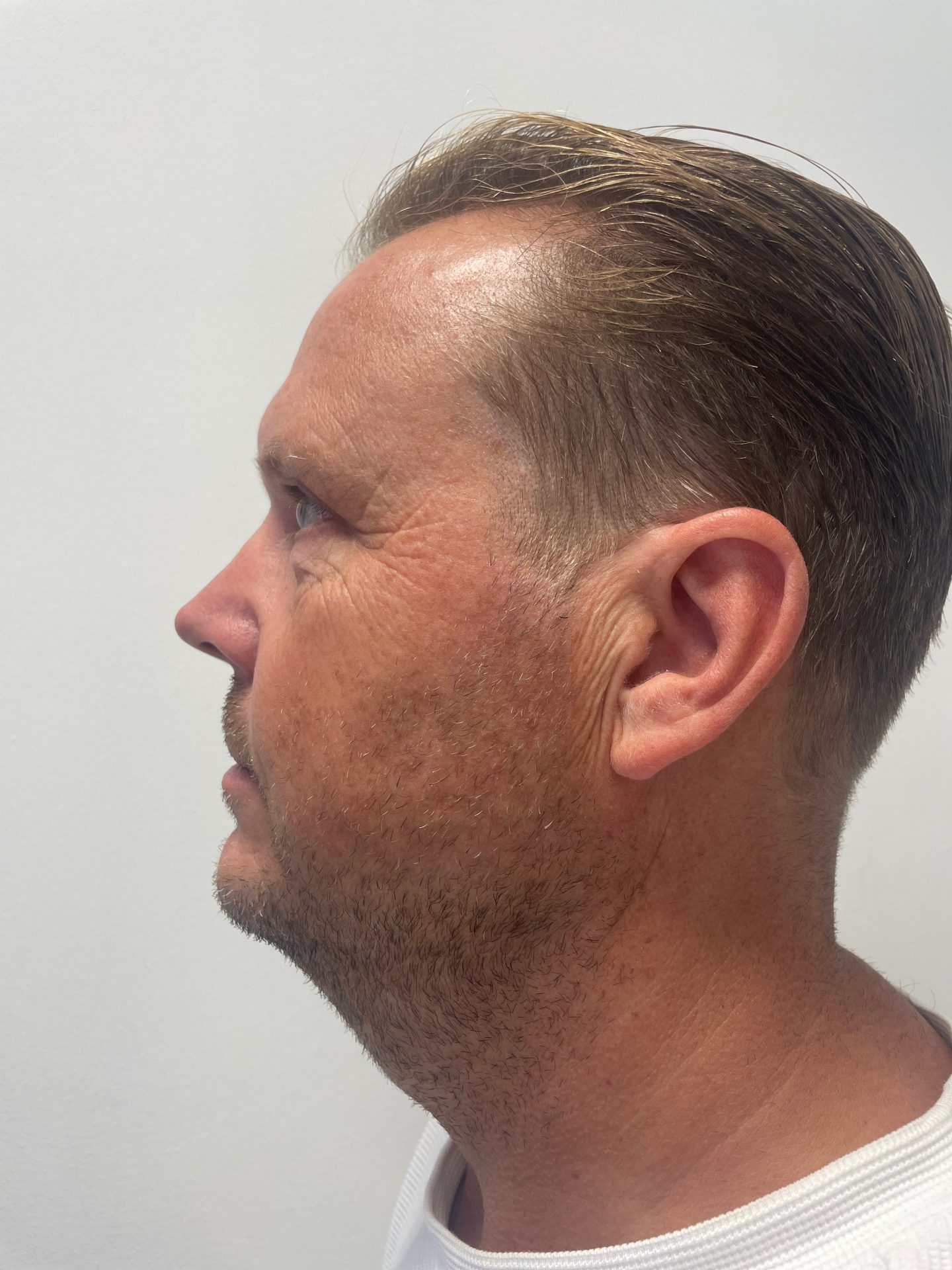 Eyelid correction after