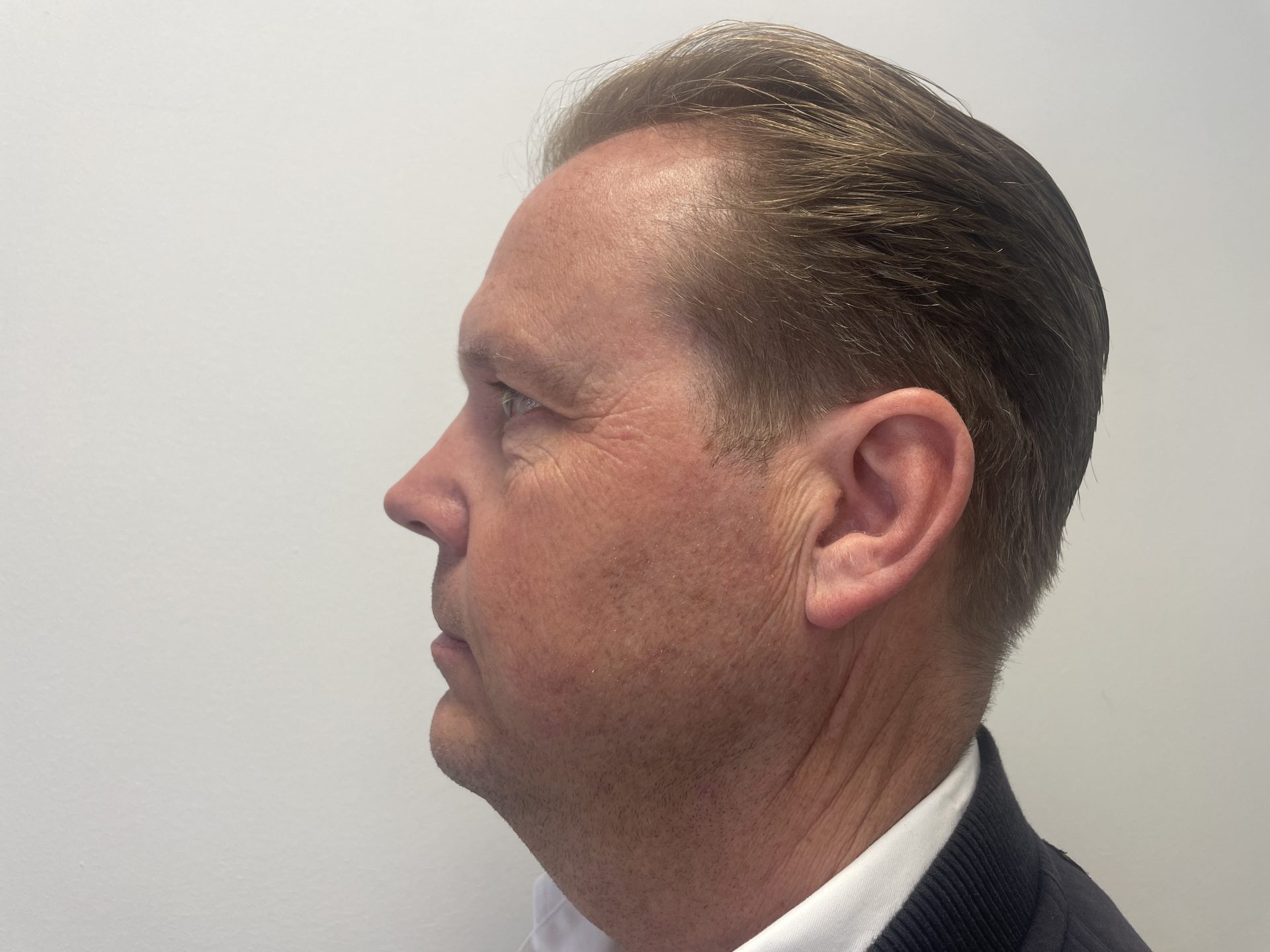 Eyelid correction before