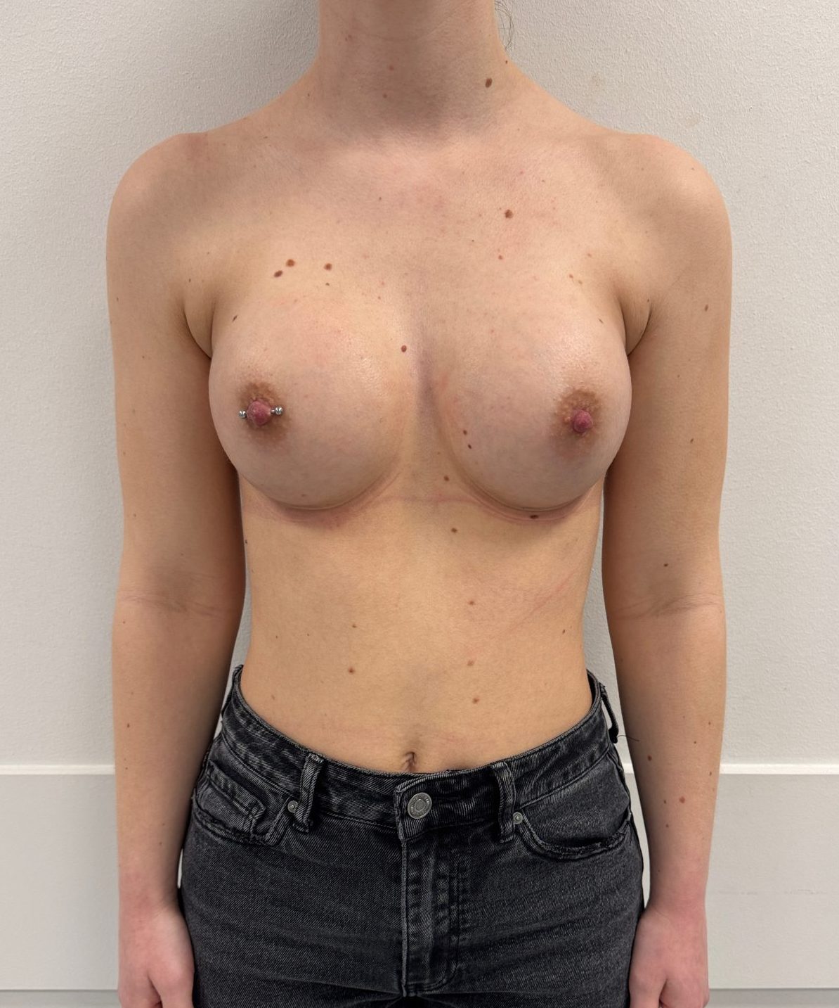 Breast augmentation after