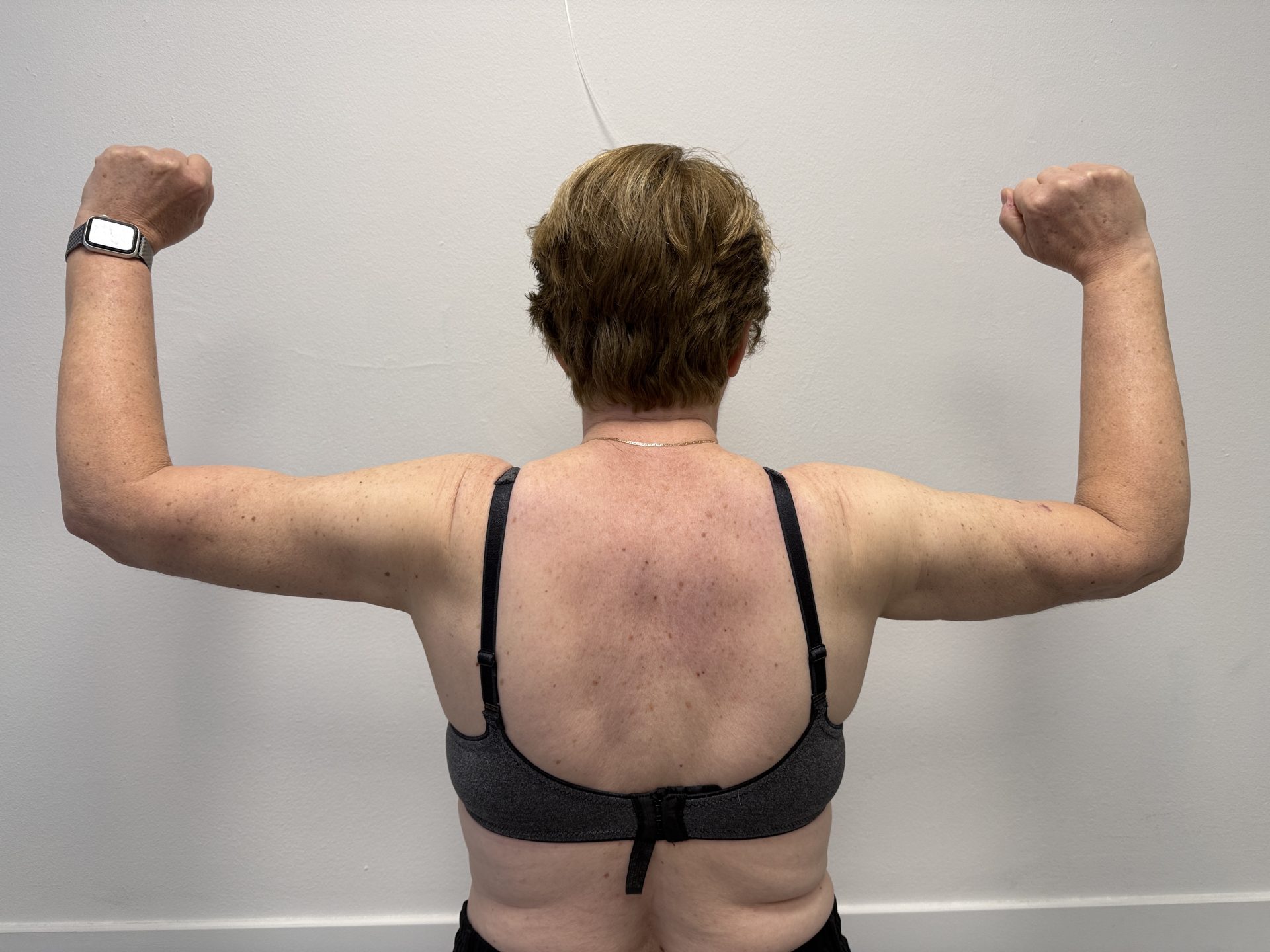 Armlift after