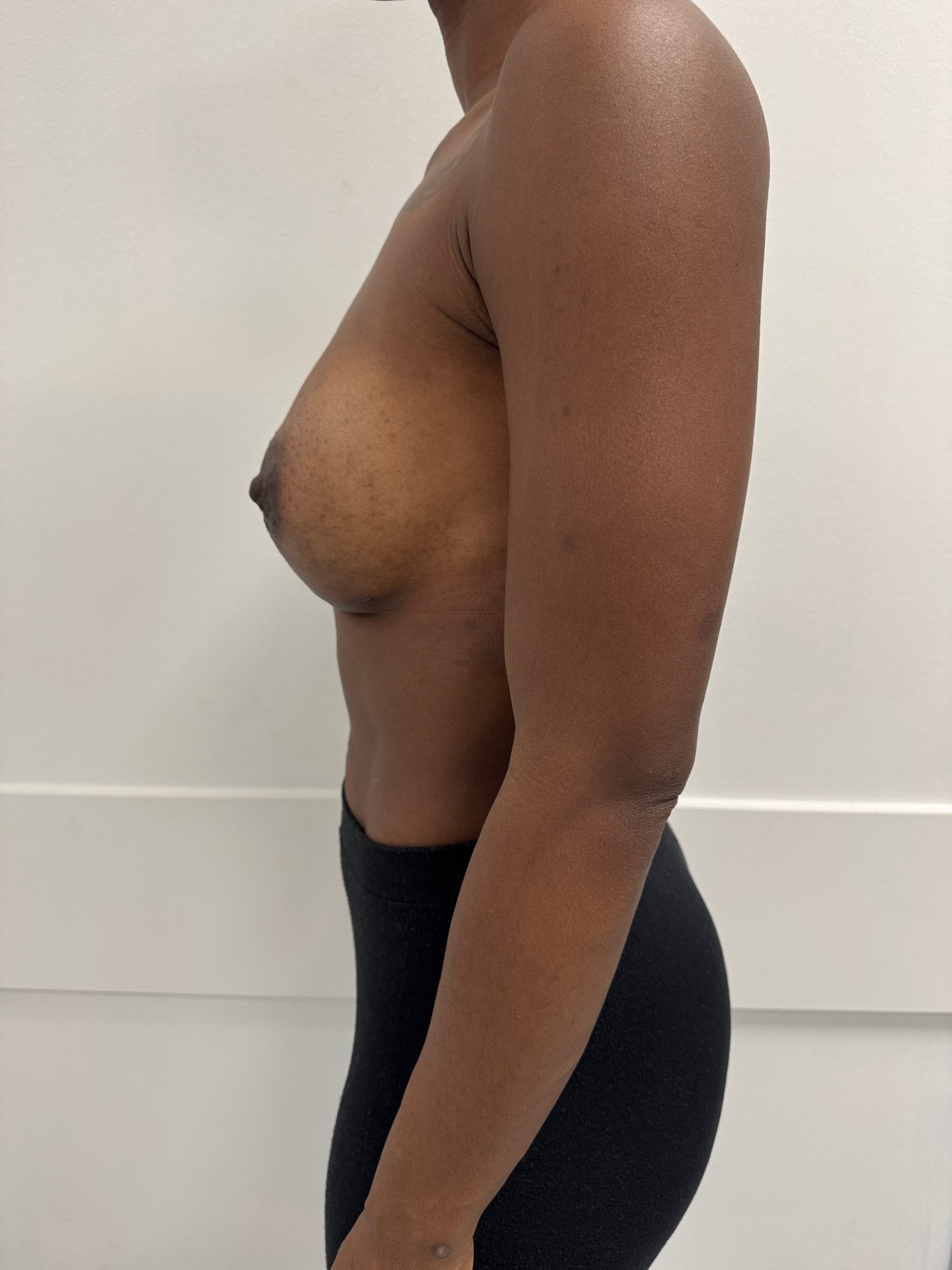 Breast augmentation after