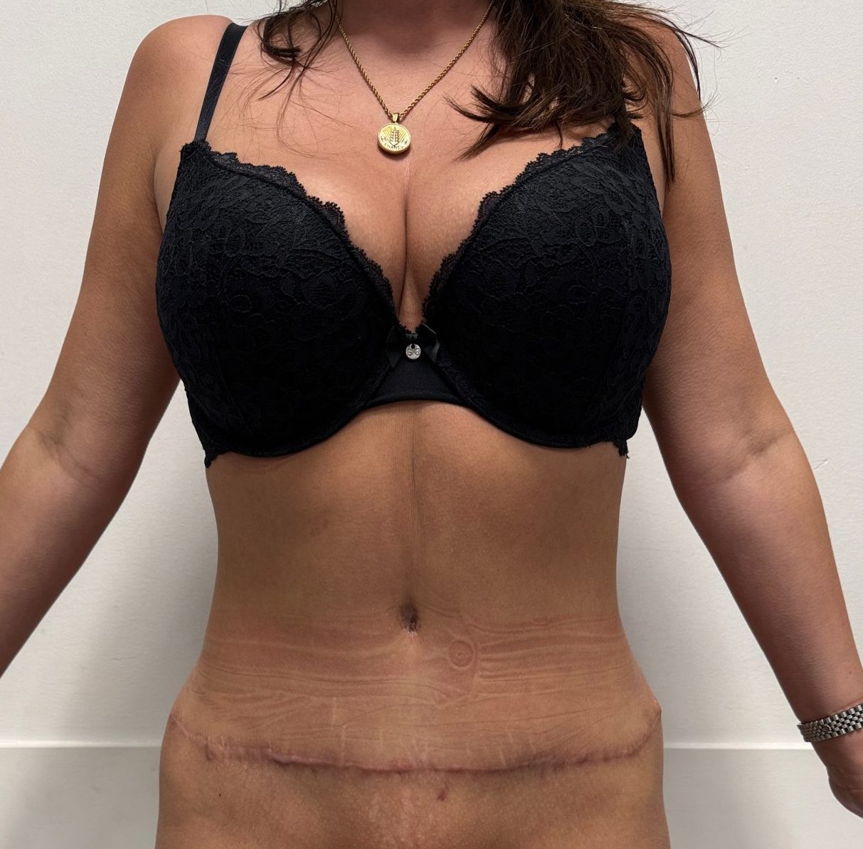 Tummy tuck after