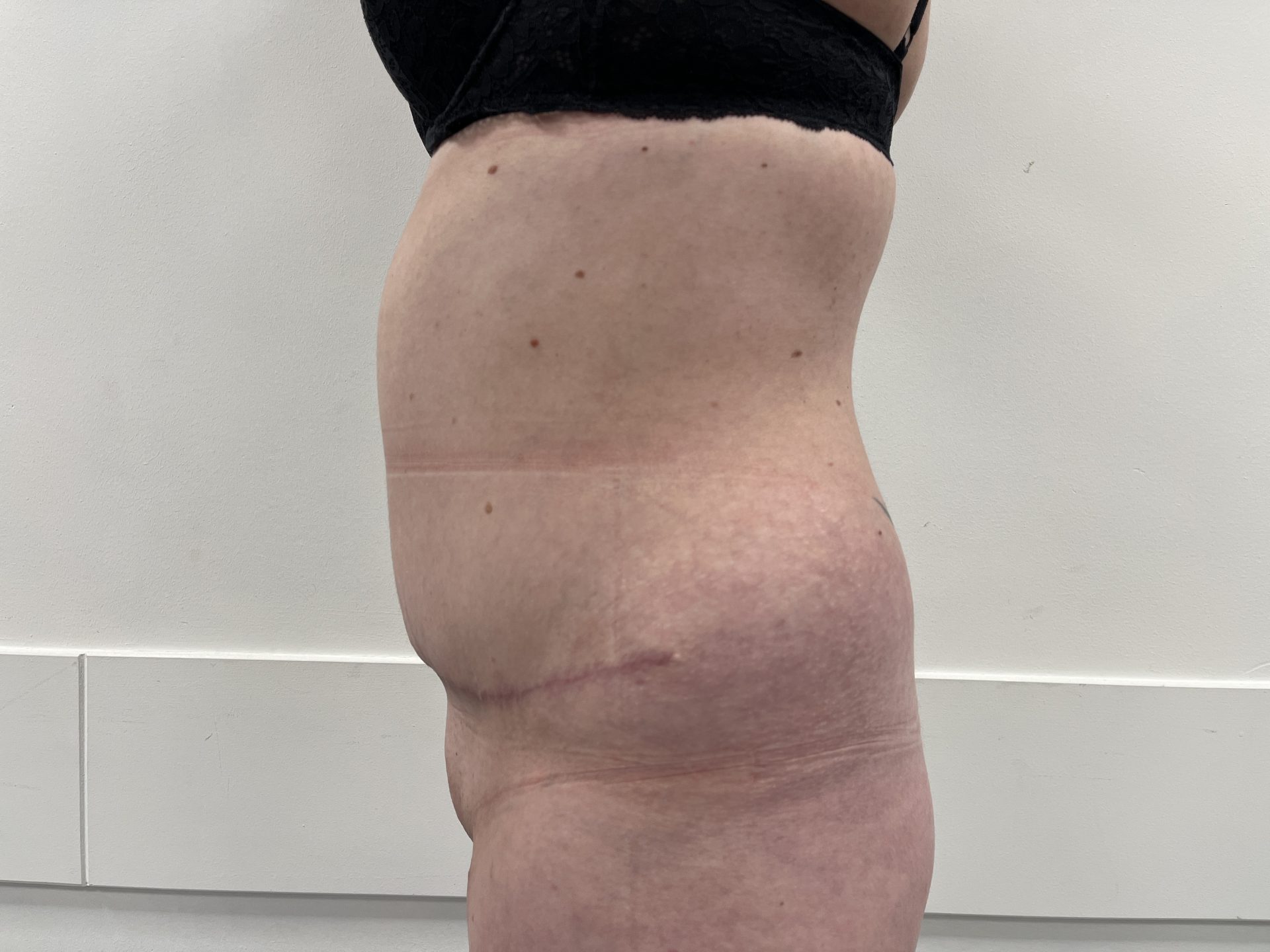 Tummy tuck after