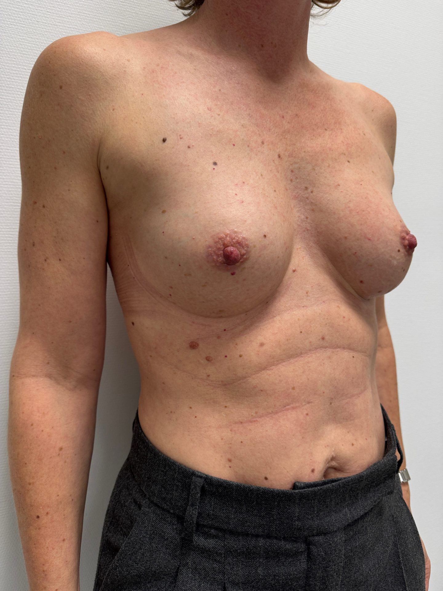 Lipofilling after