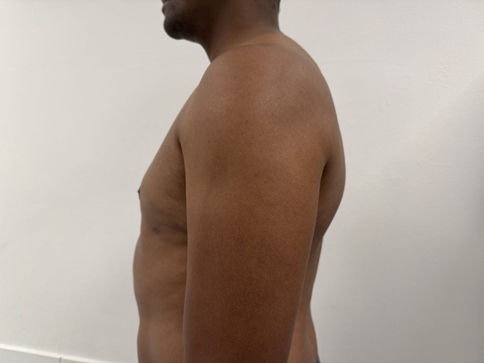 Breast correction for men after