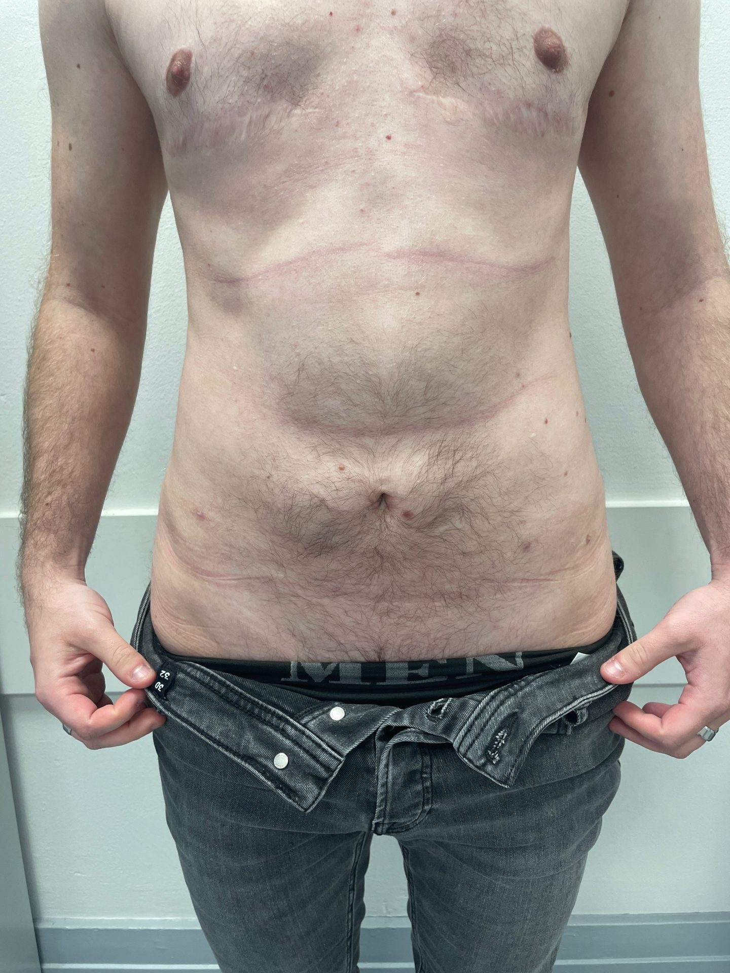 Liposuction after