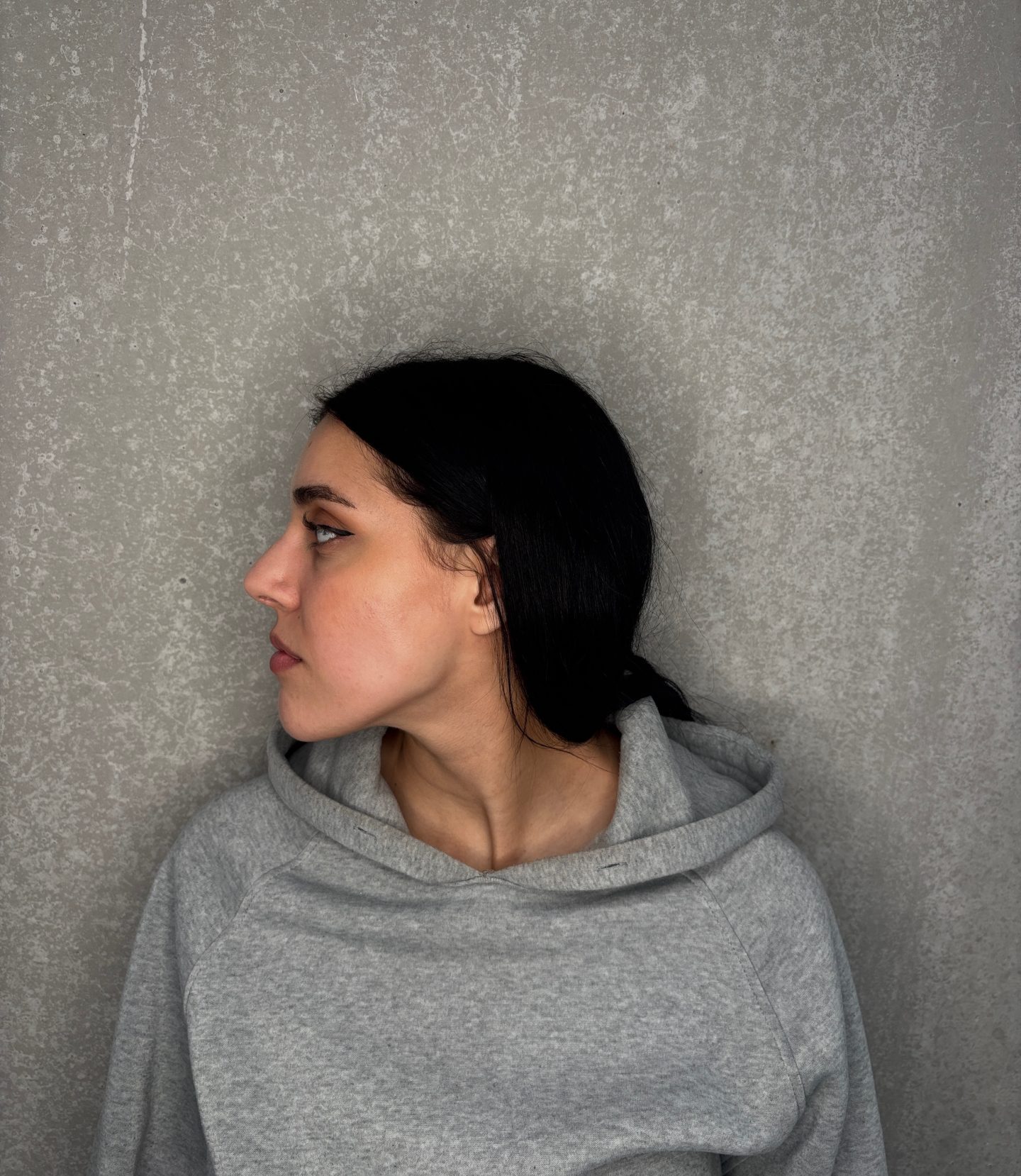 Nose correction after