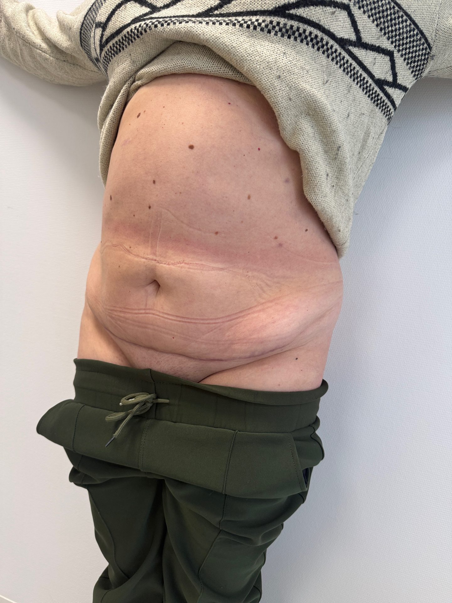 Tummy tuck after