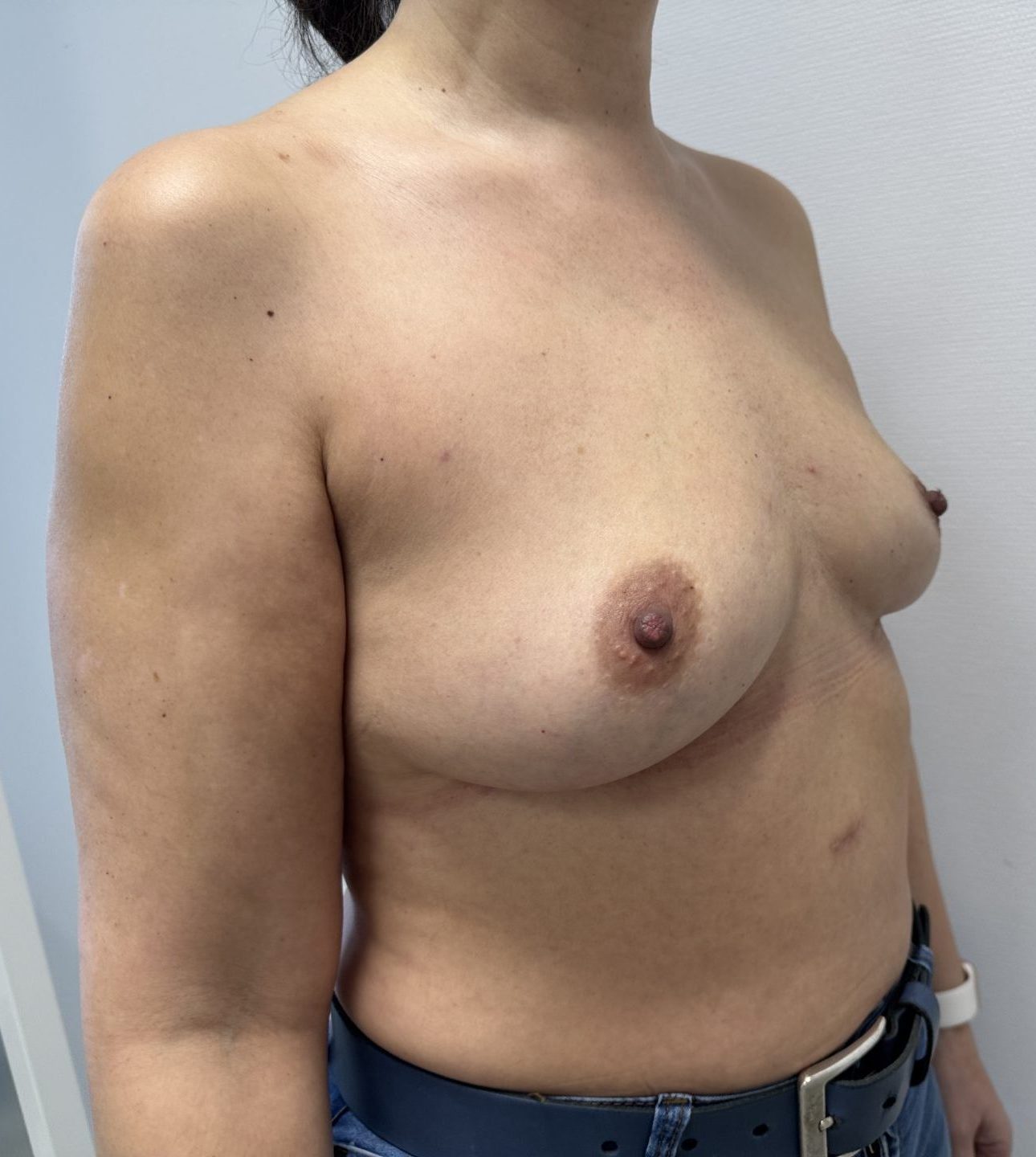 Lipofilling after