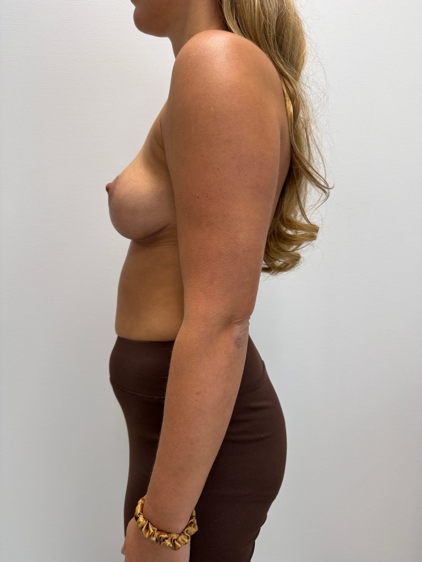 Breast lift after