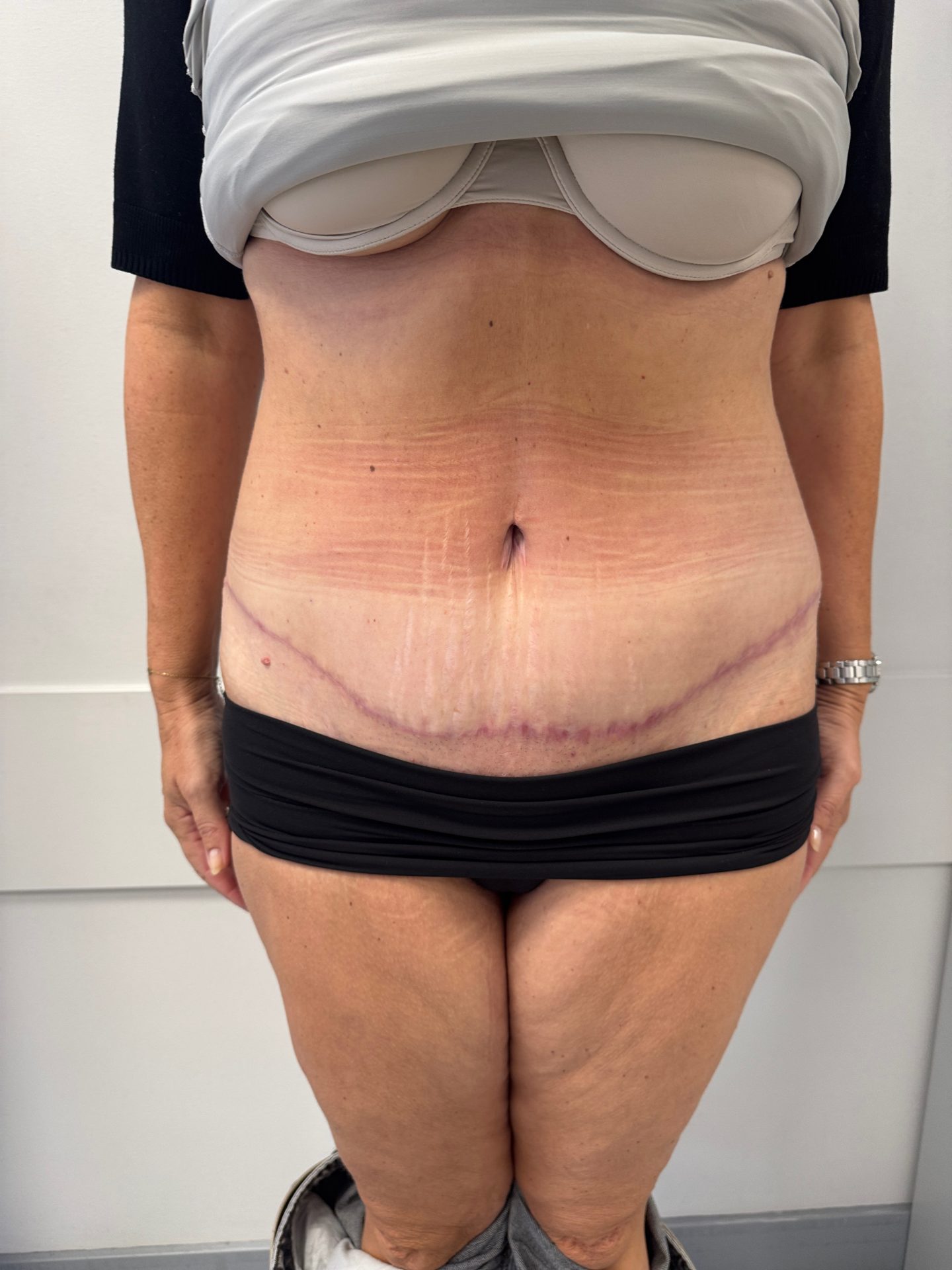 Tummy tuck after