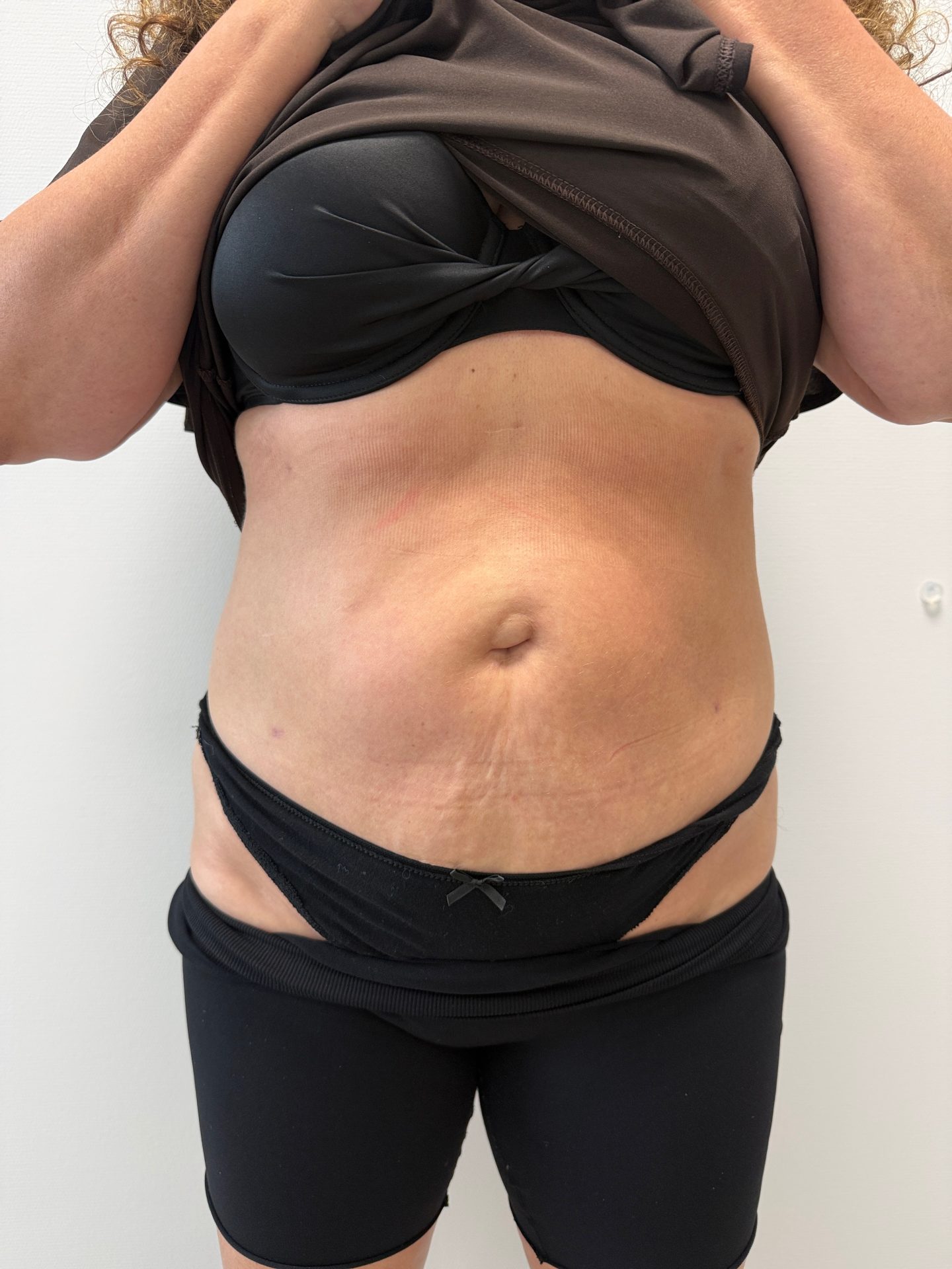 Liposuctie na