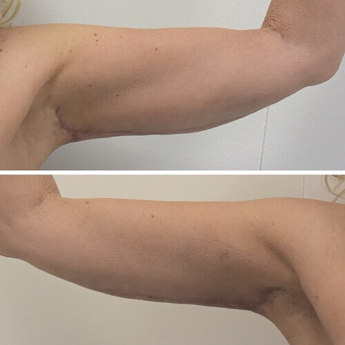 Armlift after