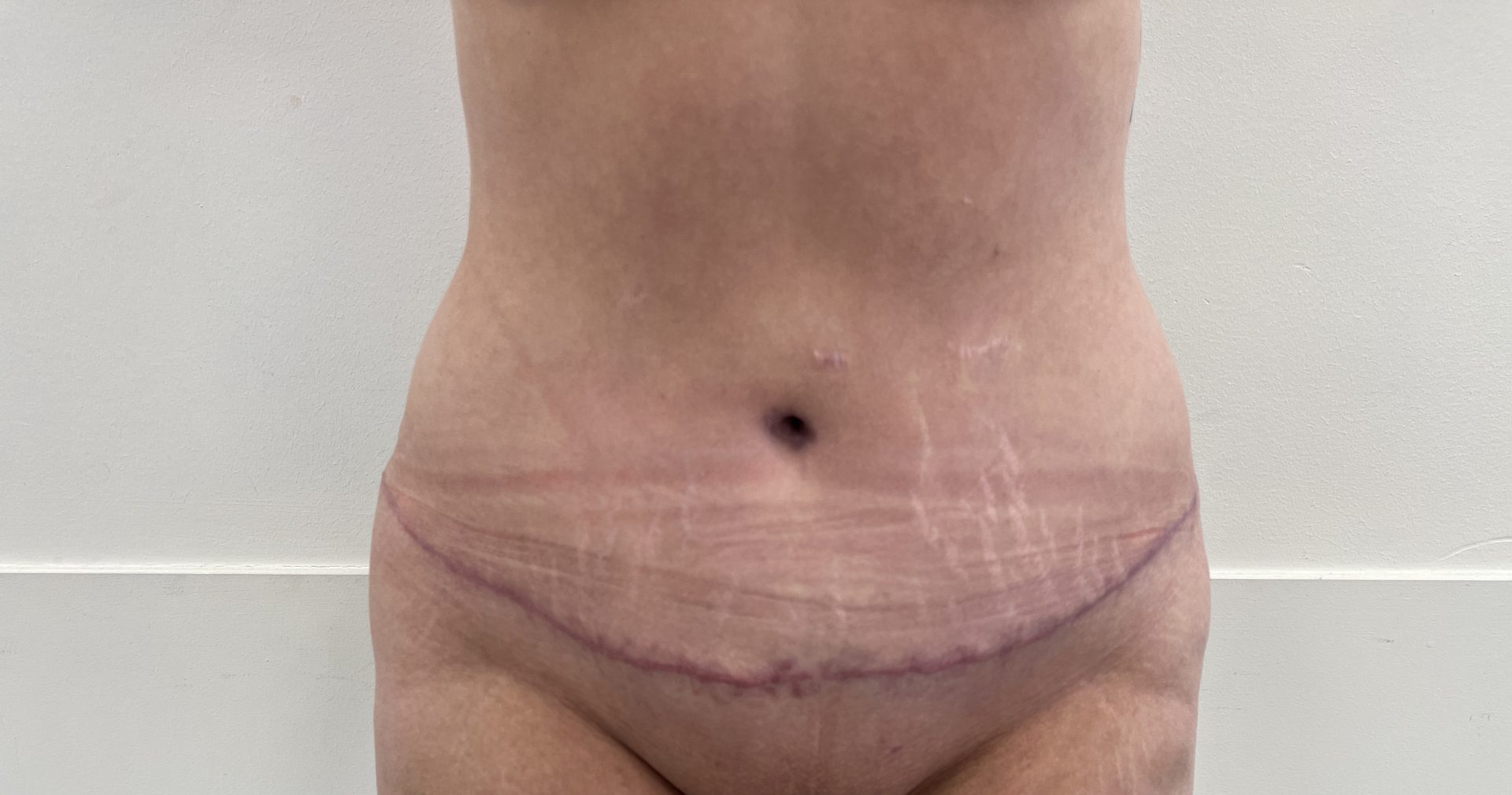 Tummy tuck after
