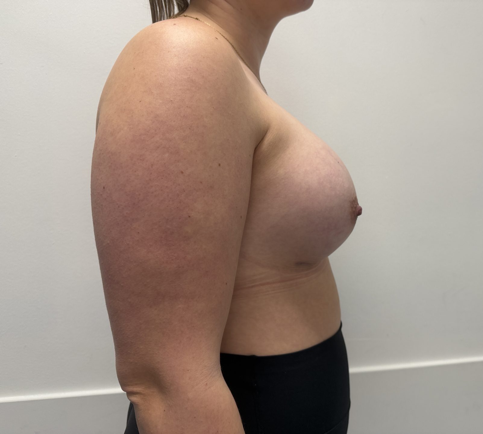 Breast augmentation after