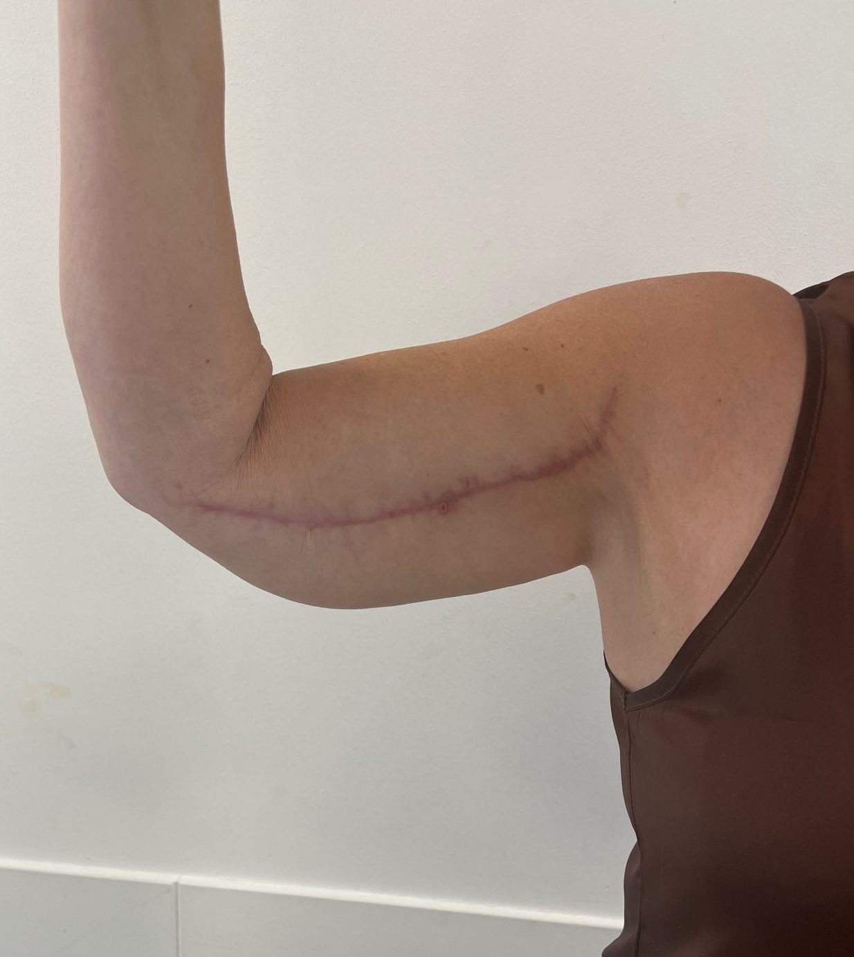 Armlift after
