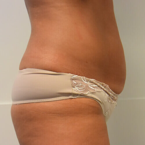 Liposuction before