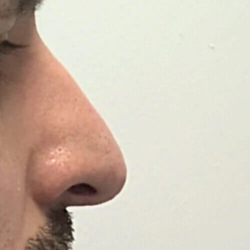 Nose correction after