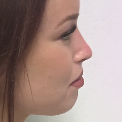 Nose correction after