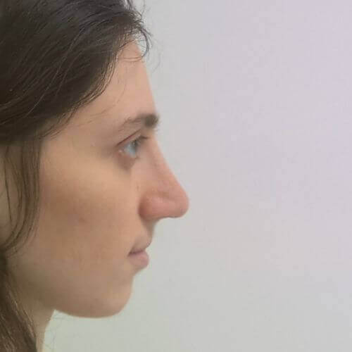 Nose correction after