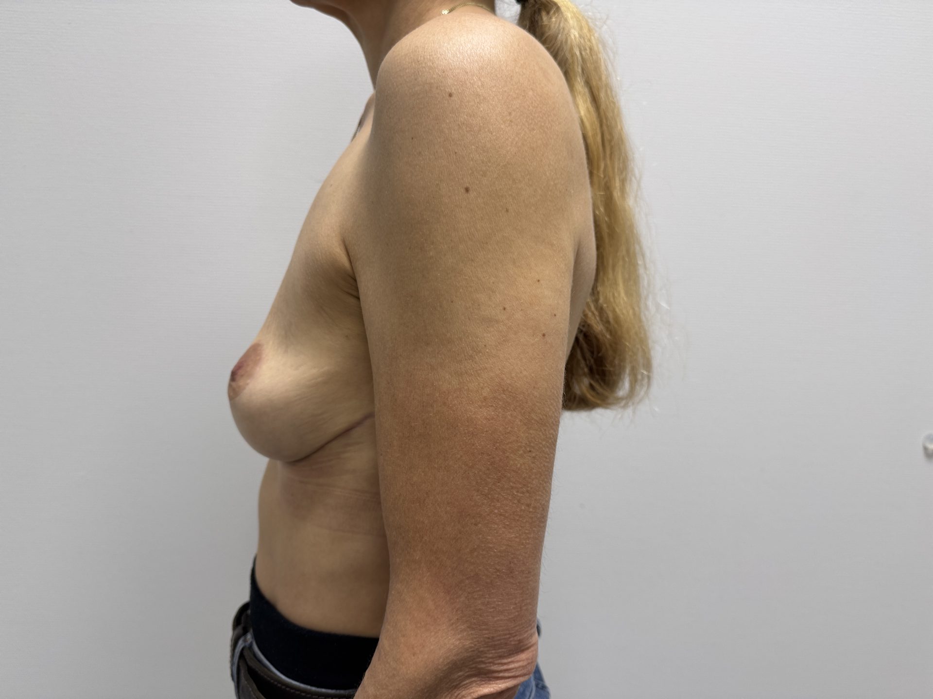 Breast lift after