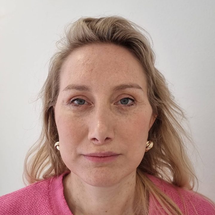 Neck facelift after