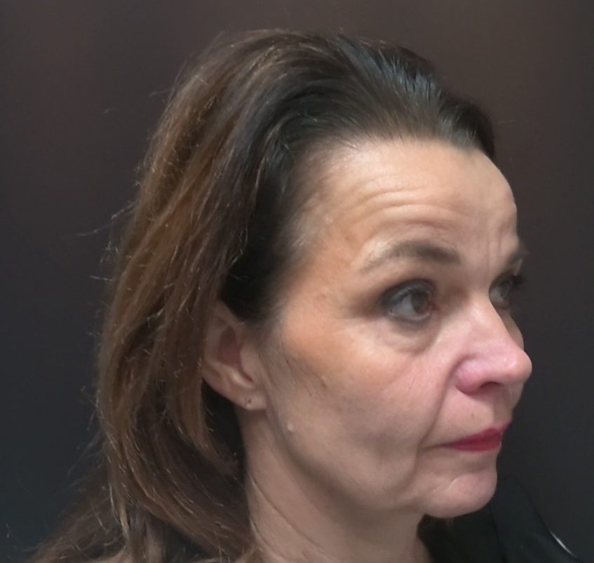 Capsular contracture and replacement of breast implants before