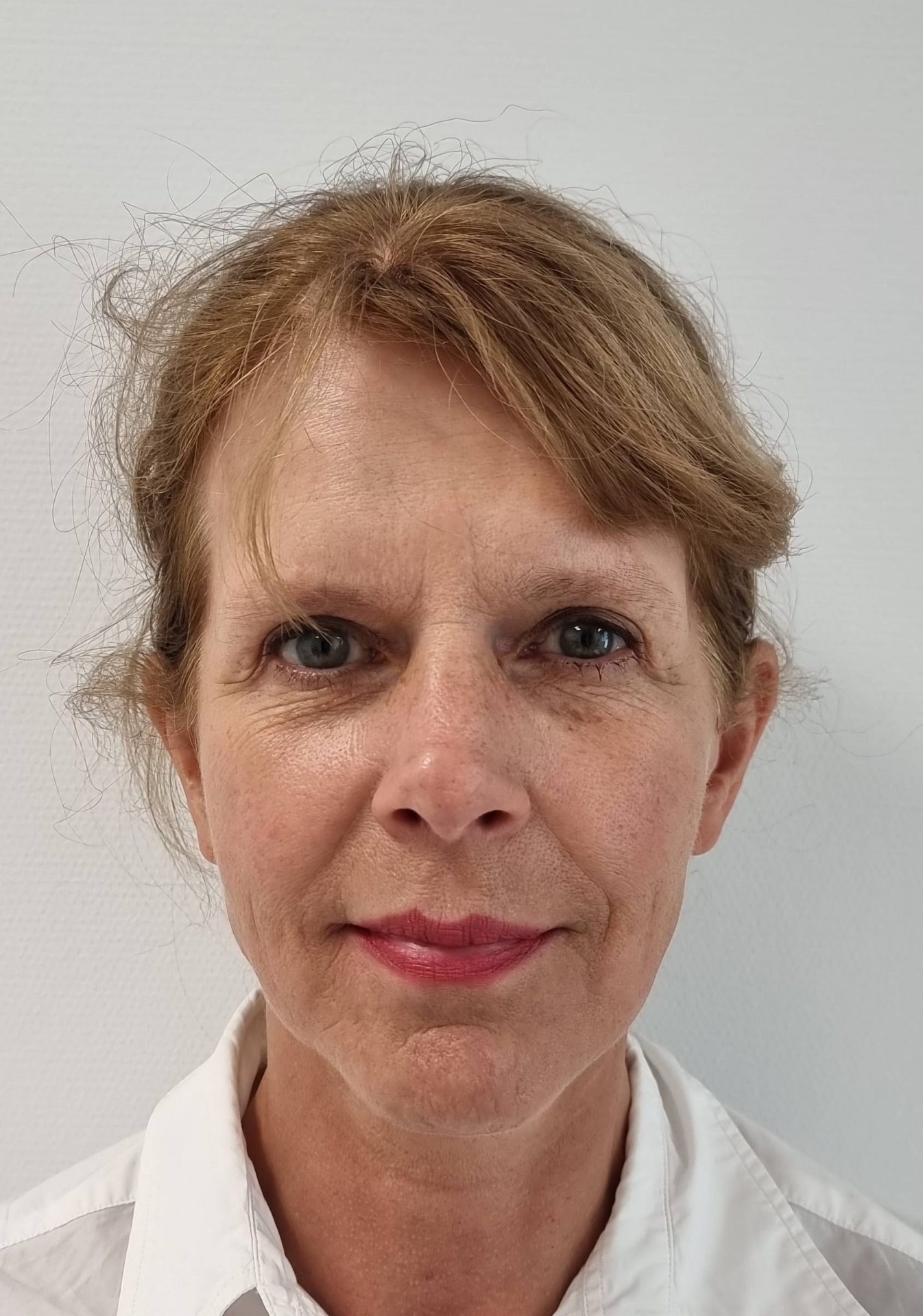 Neck facelift before