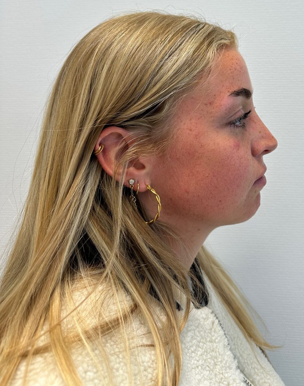 Nose correction after