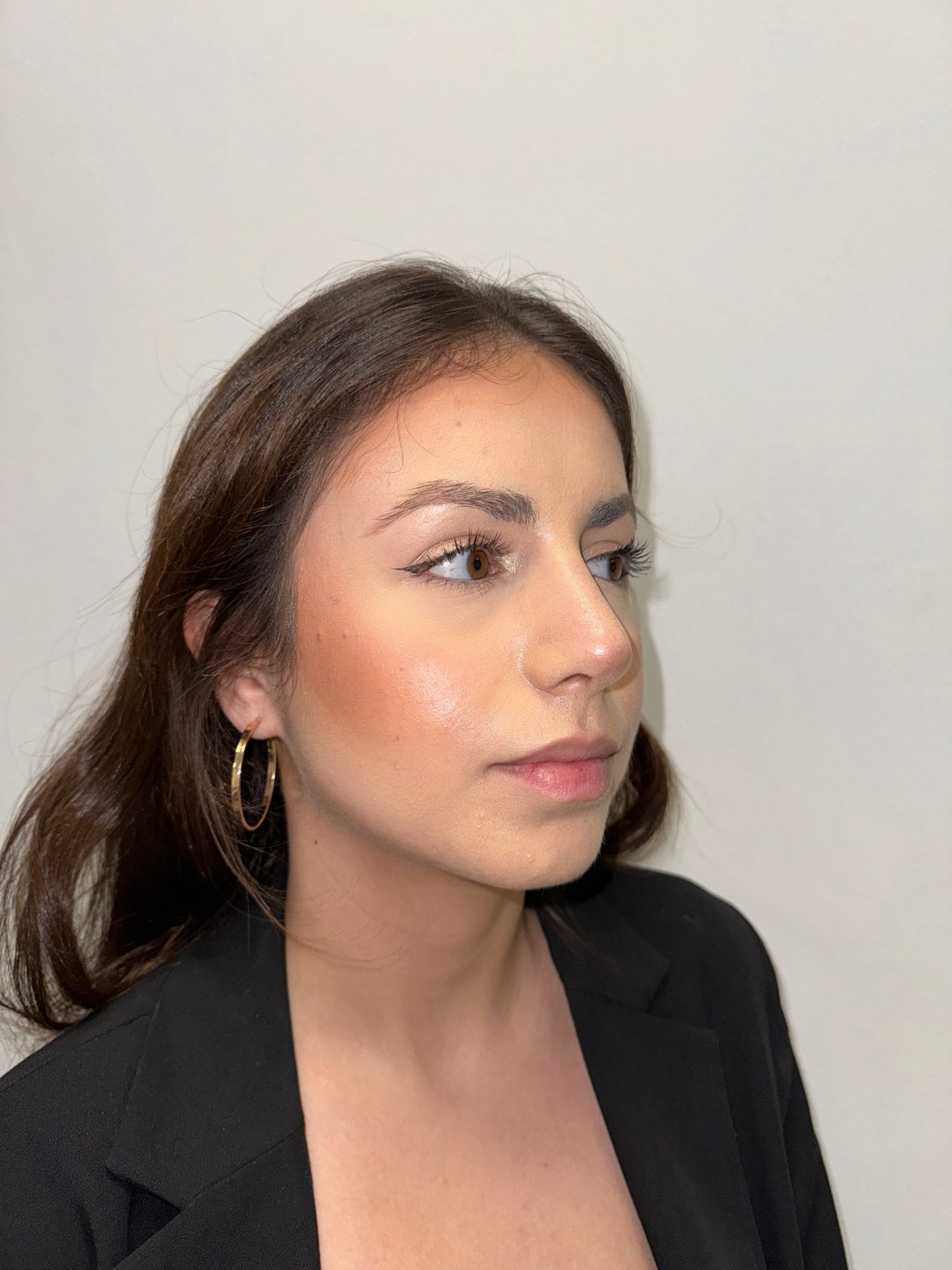 Nose correction after