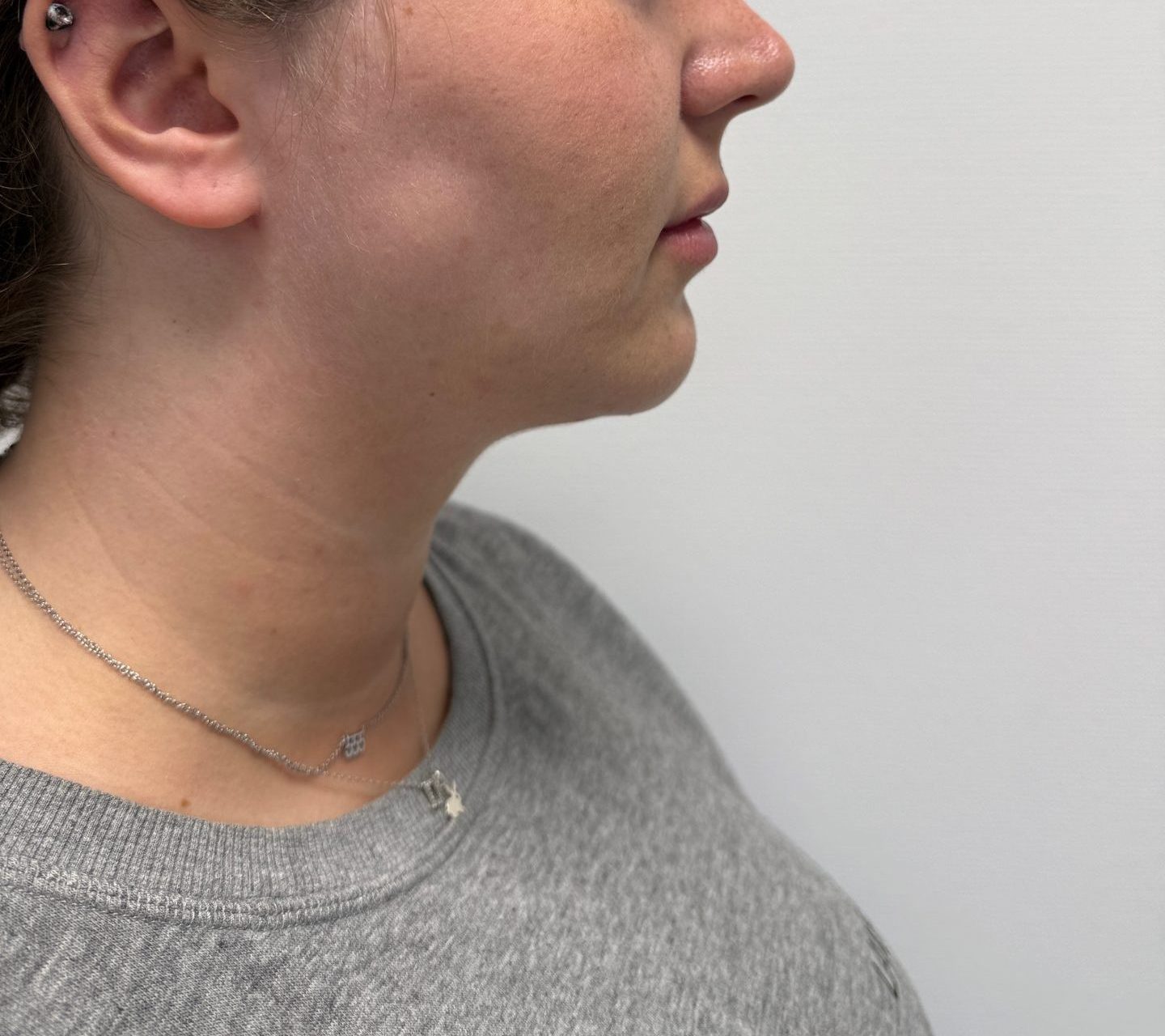 Liposuction after