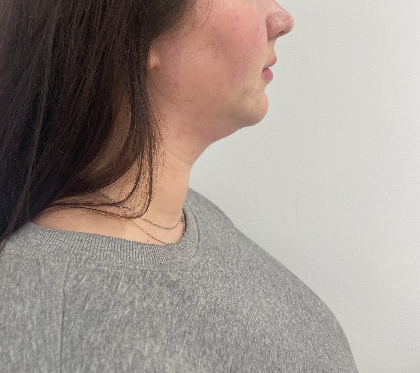 Liposuction before