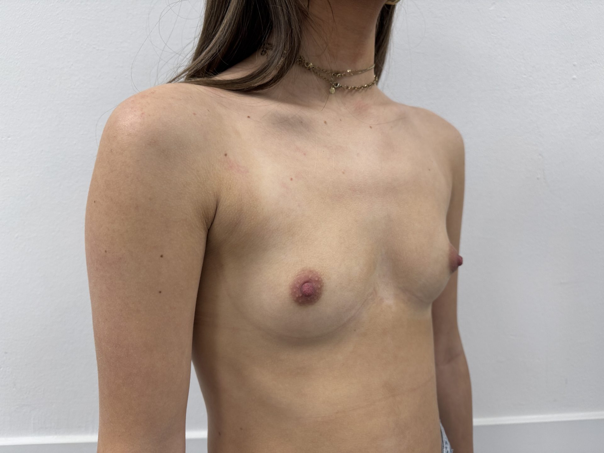 Breast augmentation before