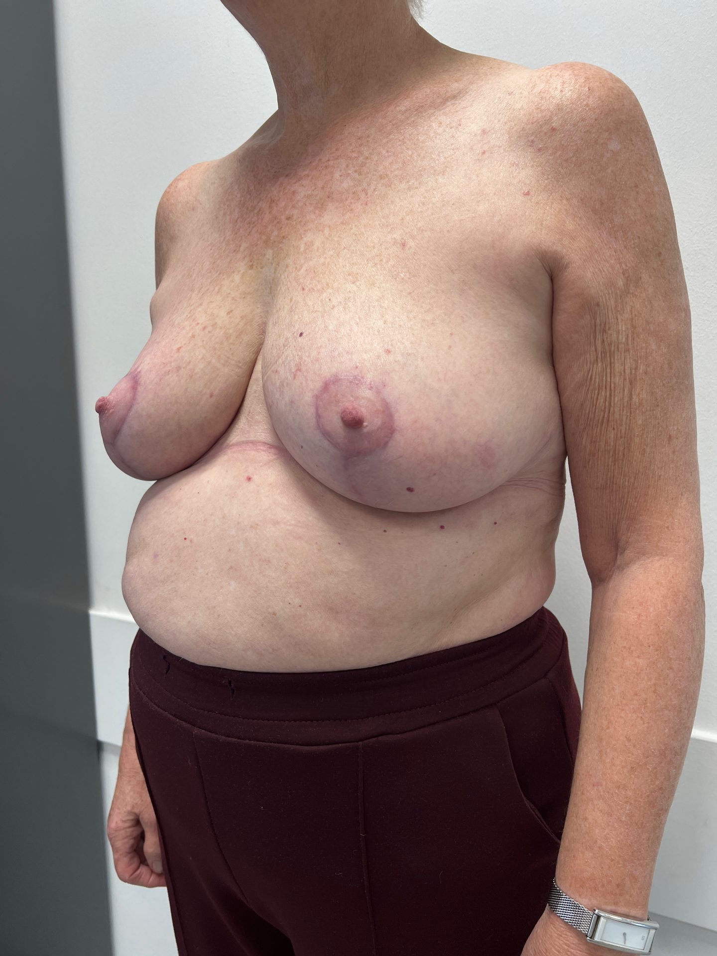 Breast reduction after
